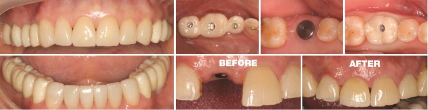 Principles, Procedures and Protocols For Restorative Implant Dentistry A Two Day Workshop (Module 1: The Partially Edentulous Arch) 